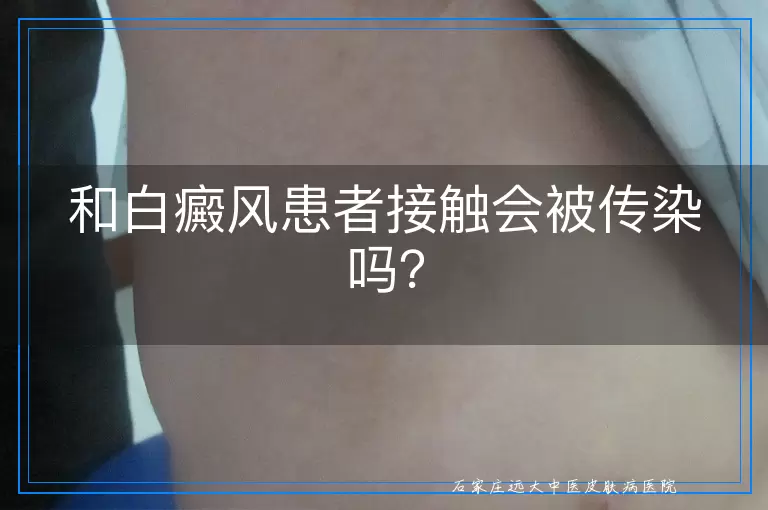 和白癜风患者接触会被传染吗？