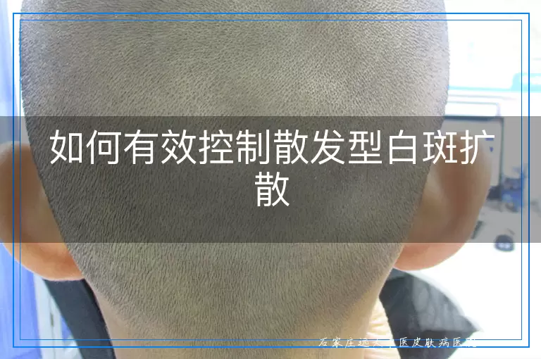 如何有效控制散发型白斑扩散