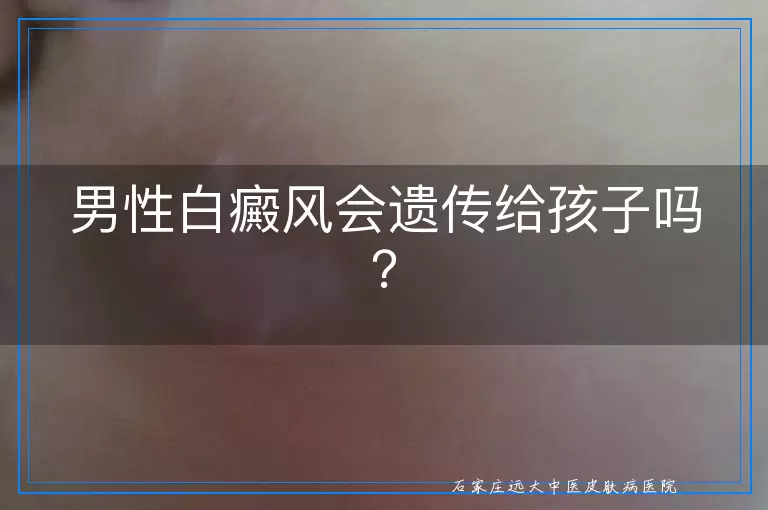男性白癜风会遗传给孩子吗？
