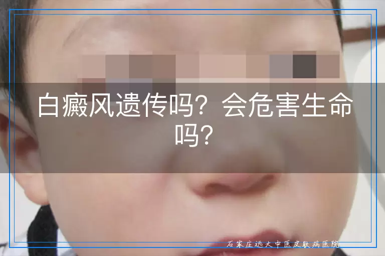 白癜风遗传吗？会危害生命吗？