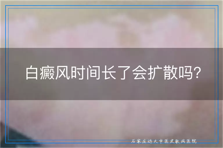 白癜风时间长了会扩散吗？