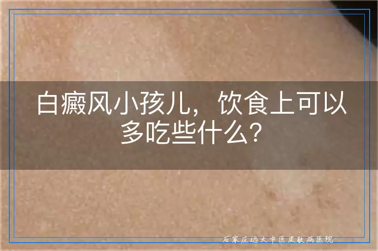 白癜风小孩儿，饮食上可以多吃些什么？