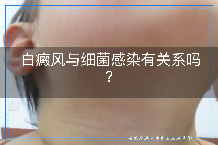 白癜风与细菌感染有关系吗？