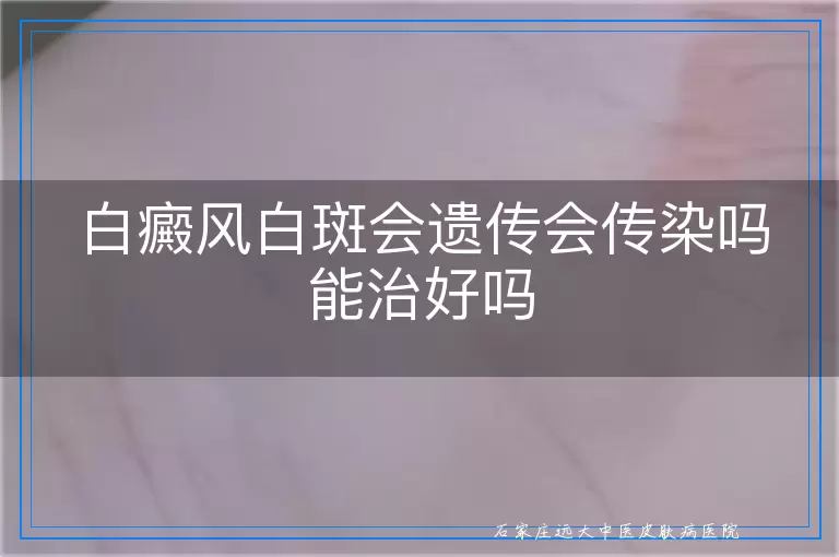 白癜风白斑会遗传会传染吗能治好吗