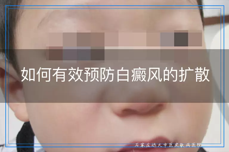 如何有效预防白癜风的扩散