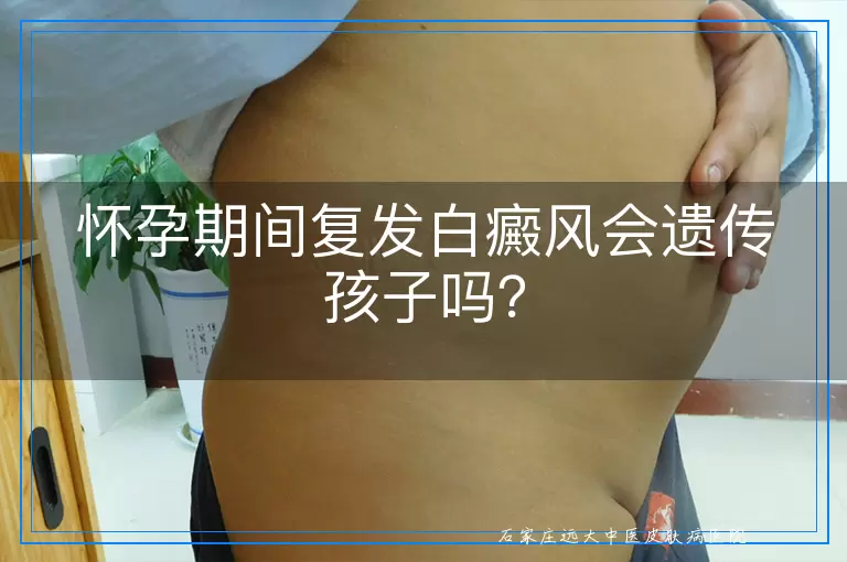 怀孕期间复发白癜风会遗传孩子吗？