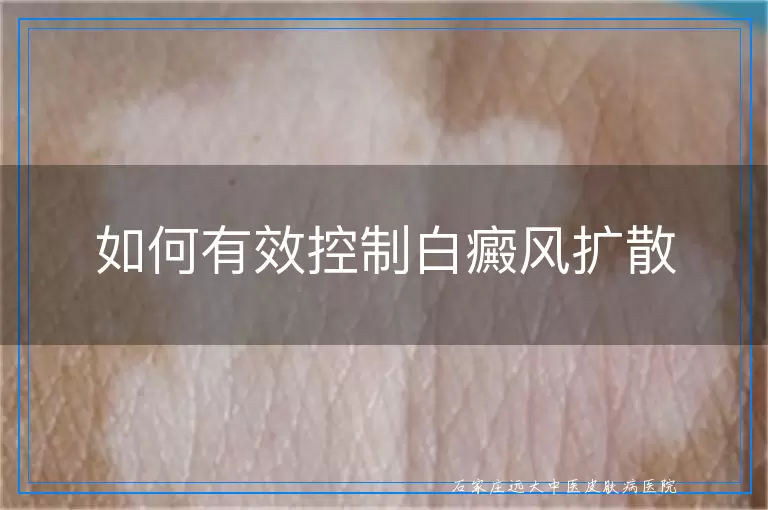 如何有效控制白癜风扩散