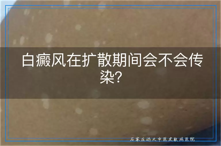 白癜风在扩散期间会不会传染？