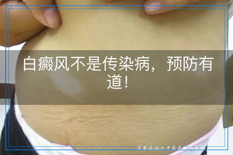 白癜风不是传染病，预防有道！