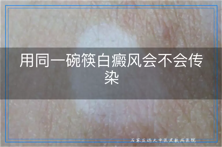 用同一碗筷白癜风会不会传染
