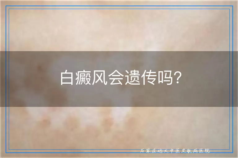 白癜风会遗传吗？