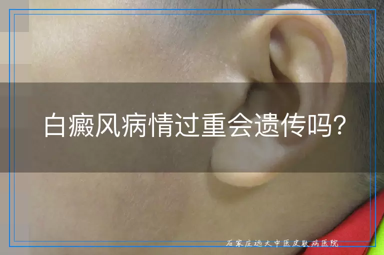 白癜风病情过重会遗传吗？