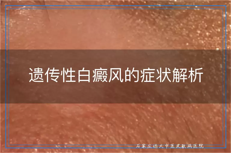遗传性白癜风的症状解析