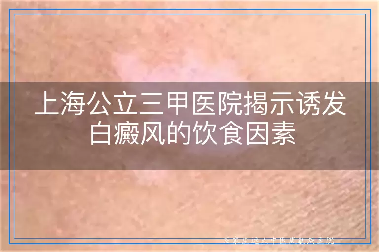 上海公立三甲医院揭示诱发白癜风的饮食因素
