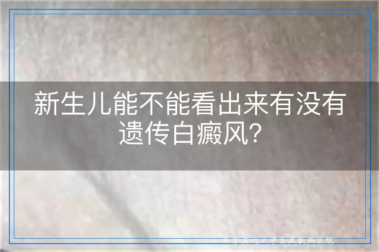 新生儿能不能看出来有没有遗传白癜风？