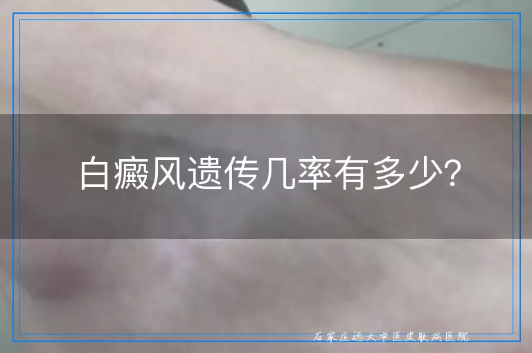 白癜风遗传几率有多少？