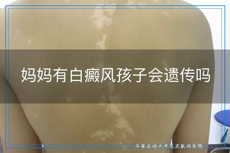 妈妈有白癜风孩子会遗传吗