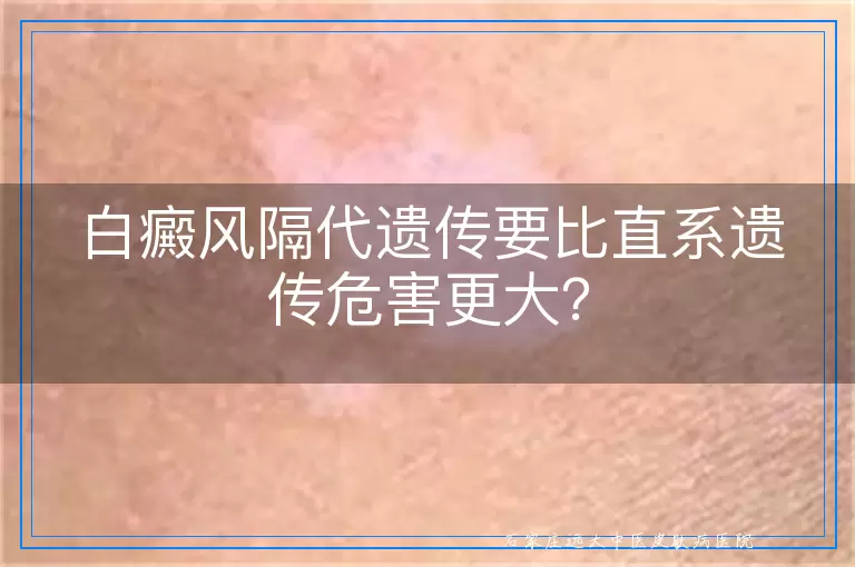 白癜风隔代遗传要比直系遗传危害更大？