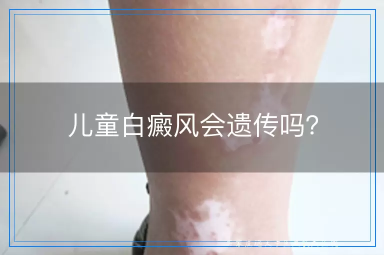 儿童白癜风会遗传吗？