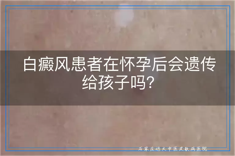 白癜风患者在怀孕后会遗传给孩子吗？