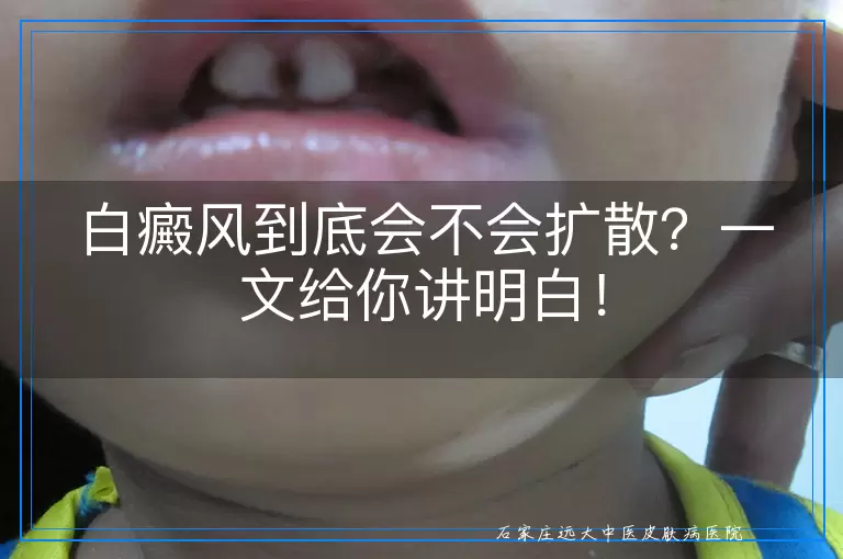 白癜风到底会不会扩散？一文给你讲明白！