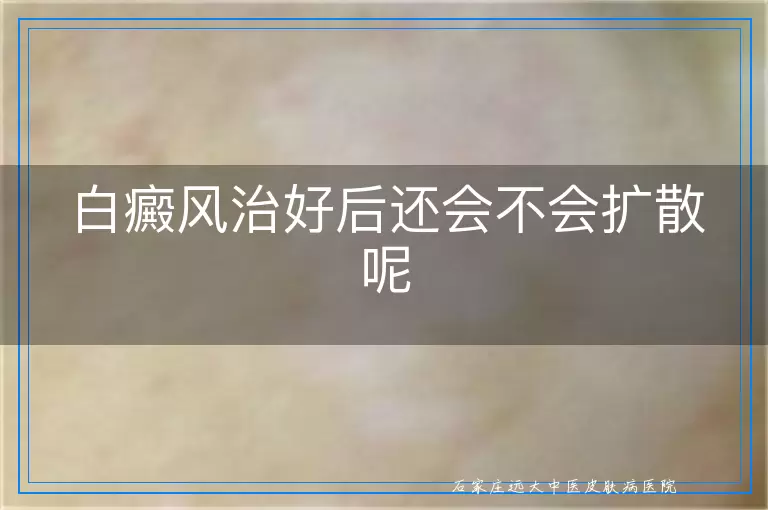 白癜风治好后还会不会扩散呢