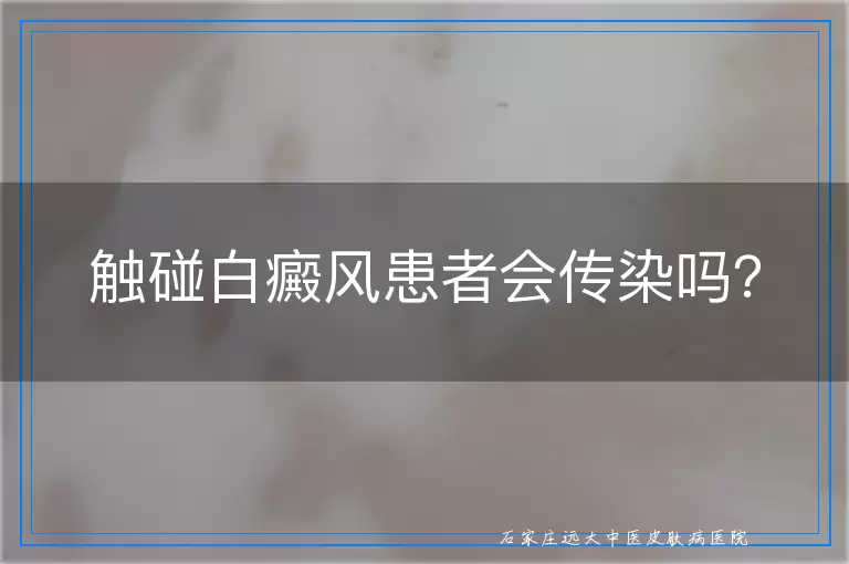 触碰白癜风患者会传染吗？