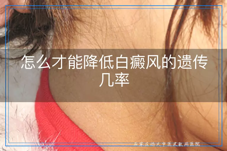 怎么才能降低白癜风的遗传几率