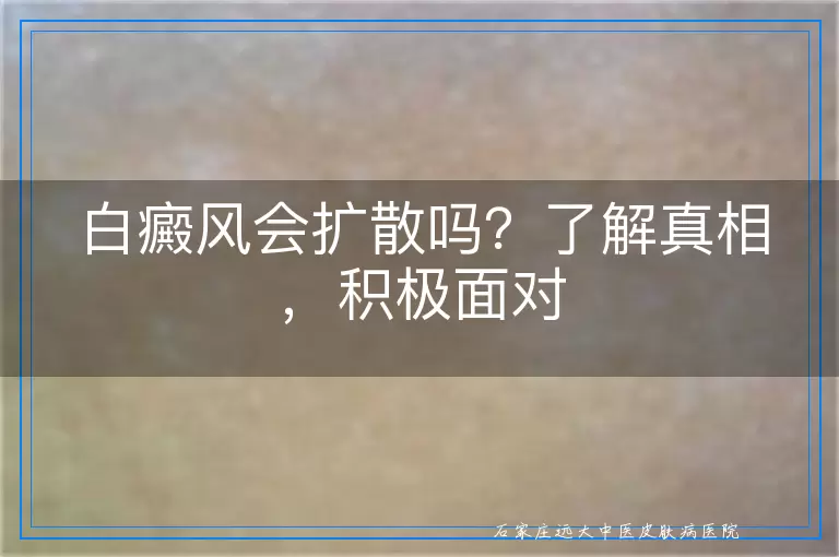 白癜风会扩散吗？了解真相，积极面对