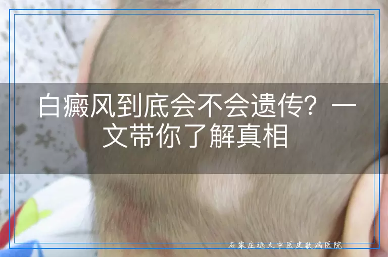 白癜风到底会不会遗传？一文带你了解真相