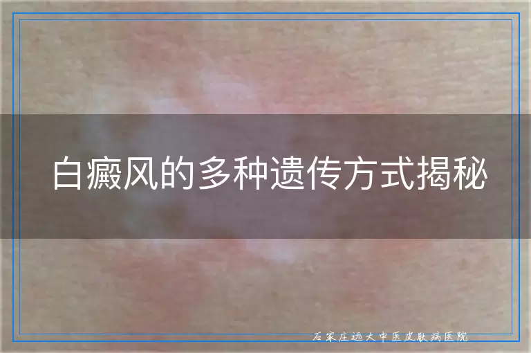 白癜风的多种遗传方式揭秘