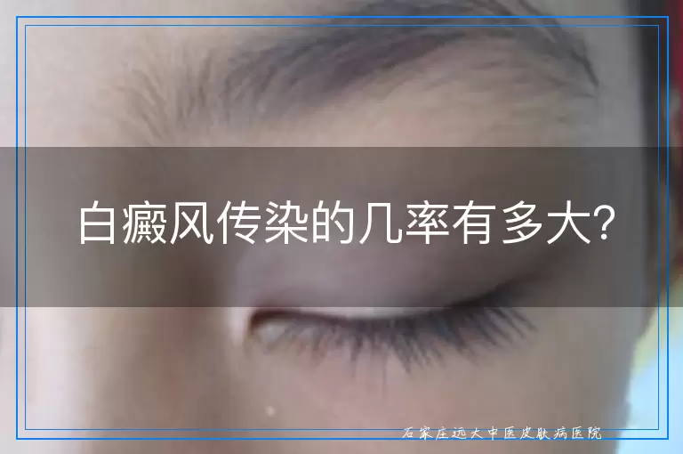 白癜风传染的几率有多大？