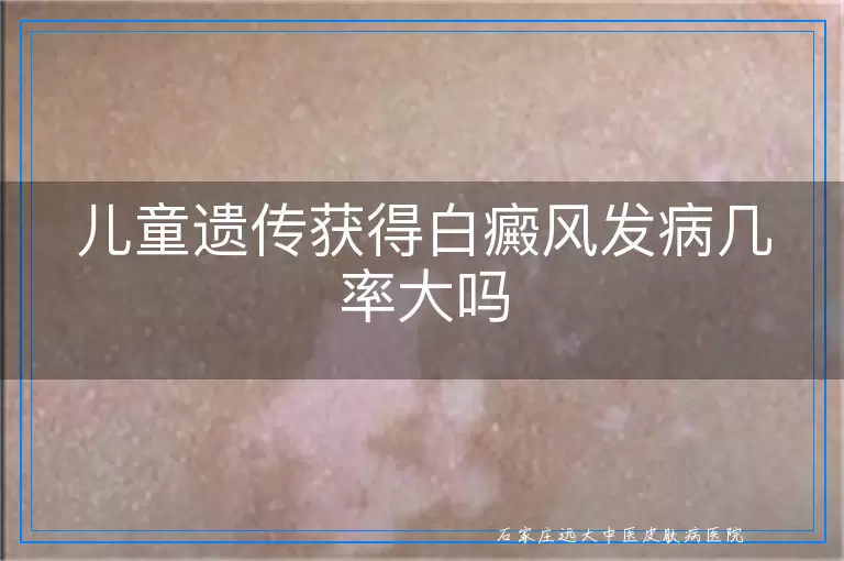 儿童遗传获得白癜风发病几率大吗