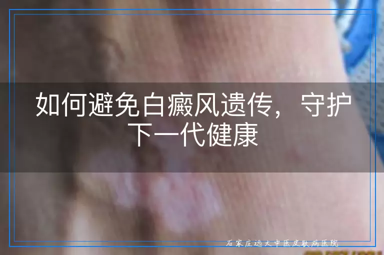如何避免白癜风遗传，守护下一代健康