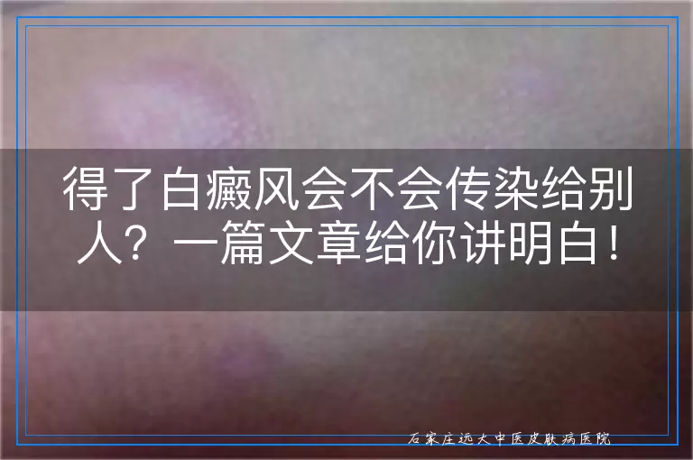得了白癜风会不会传染给别人？一篇文章给你讲明白！