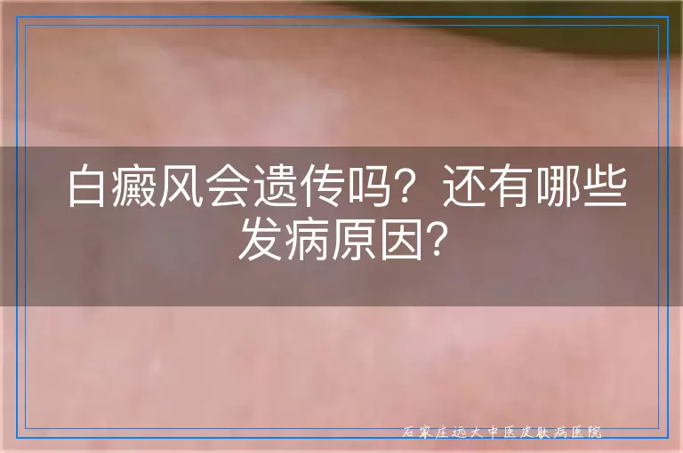 白癜风会遗传吗？还有哪些发病原因？