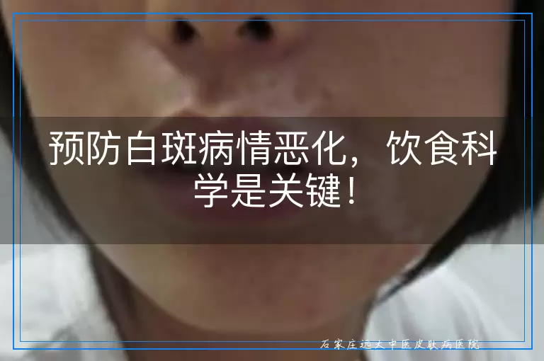 预防白斑病情恶化，饮食科学是关键！