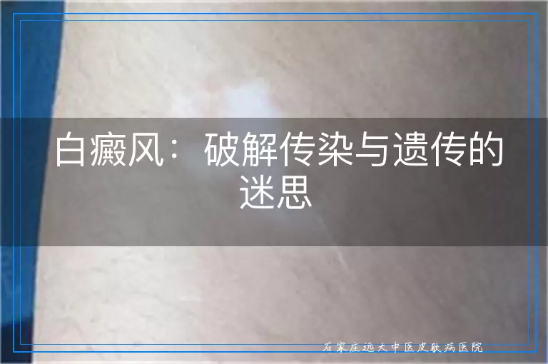白癜风：破解传染与遗传的迷思