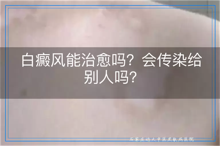 白癜风能治愈吗？会传染给别人吗？