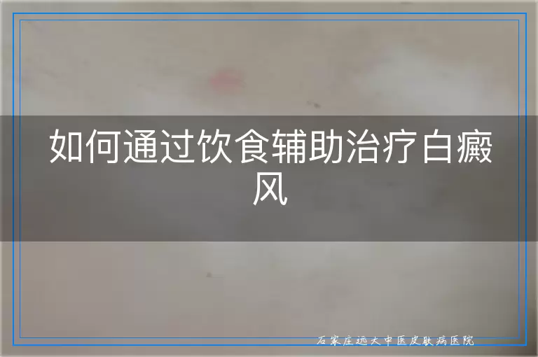 如何通过饮食辅助治疗白癜风