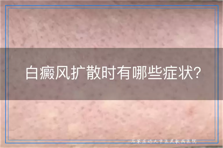 白癜风扩散时有哪些症状？