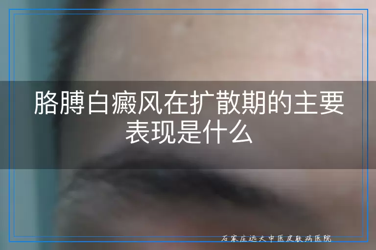 胳膊白癜风在扩散期的主要表现是什么