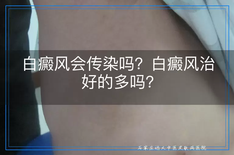 白癜风会传染吗？白癜风治好的多吗？