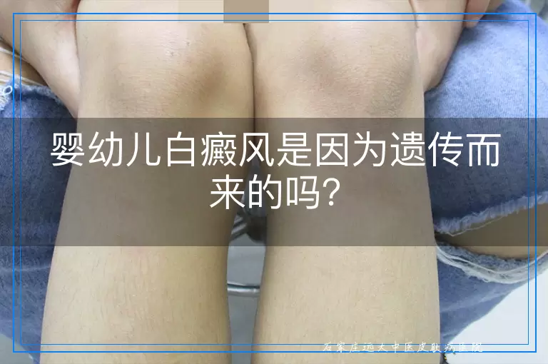 婴幼儿白癜风是因为遗传而来的吗？