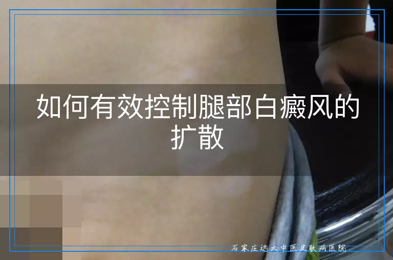 如何有效控制腿部白癜风的扩散