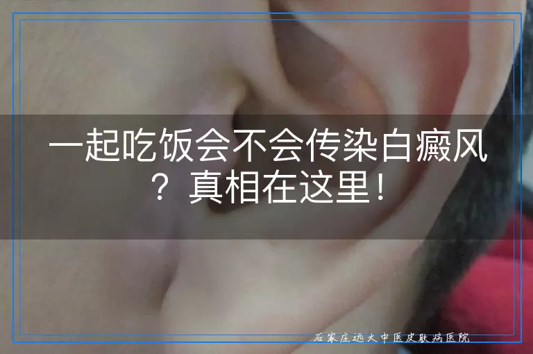 一起吃饭会不会传染白癜风？真相在这里！