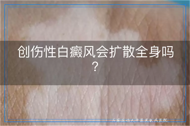 创伤性白癜风会扩散全身吗？