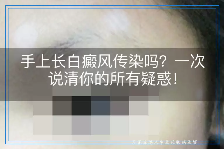 手上长白癜风传染吗？一次说清你的所有疑惑！