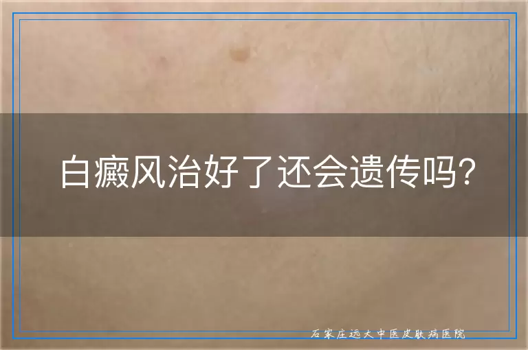 白癜风治好了还会遗传吗？