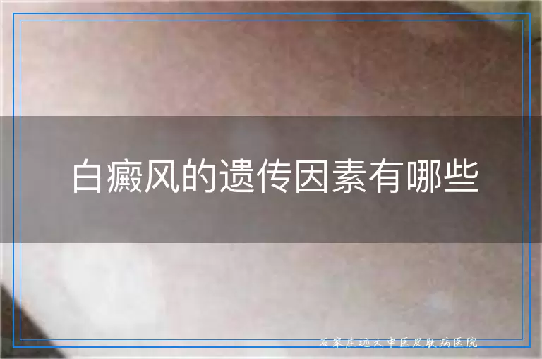 白癜风的遗传因素有哪些